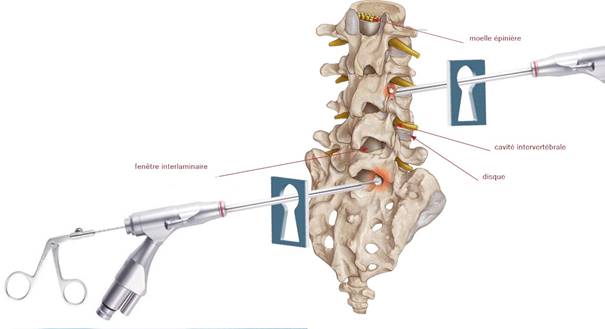 endoskopische Bandscheibenoperation